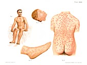 Smallpox and chicken pox, illustration