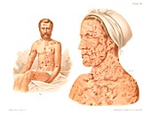 Pemphigus, historical illustration