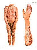 Psoriasis, historical illustration