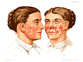Lupus erythematosus and vulgaris, illustration