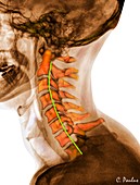 Curvature of the cervical spine, X-ray