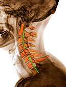Dislocated cervical vertebra, X-ray