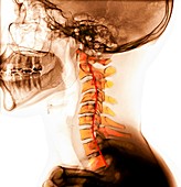 Kyphosis of the cervical spine, X-rays