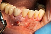 Dental abscess