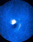 Eye angiography
