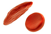 Sickle cell red blood cells, illustration