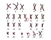 Philadelphia chromosome, illustration