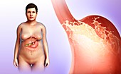 Female stomach acidity, illustration