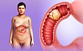 Female intestinal cancer, illustration