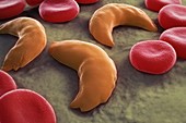 Sickle-cell Disease, artwork