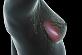 Breast Implant, artwork