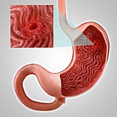 Gastric Ulcer, artwork