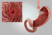 Gastric Ulcer, artwork