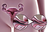Tubal Ligation Metal Implant