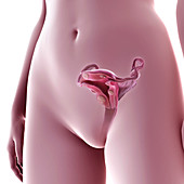 Uterine Fibroids, illustration