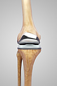 Knee Replacement, illustration