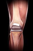 Knee Replacement, illustration