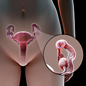 Ectopic Pregnancy, illustration