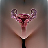 Uterine Fibroids, illustration