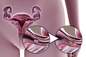 Tubal Ligation Silicone Implant