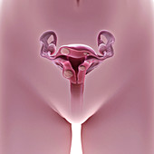 Uterine Fibroids, illustration