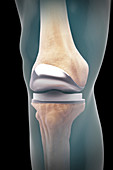 Knee Replacement, illustration