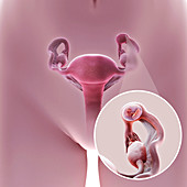 Ectopic Pregnancy, illustration