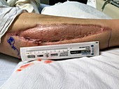 Skin graft after fasciotomy