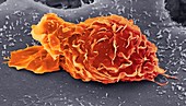 Bone cancer cell, SEM