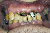 Dental abscess