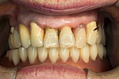 Ceramic dental crowns