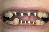 Dental bridge preparation