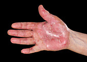 Psoriasis on a hand