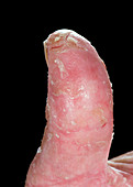 Psoriasis on a thumb