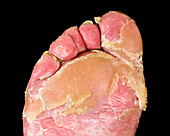 Psoriasis on a foot