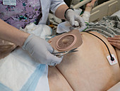 Fitting a colostomy bag