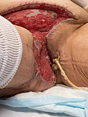 Failed skin graft in tissue infection