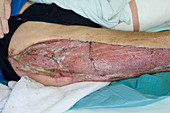 Leg being treated for necrotizing fasciitis
