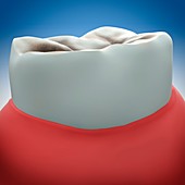 Molar tooth decay, illustration
