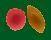 Sickle cell and normal red blood cell, SEM