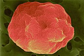 Red blood cell infected with malaria parasite, SEM