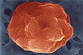 Red blood cell infected with malaria parasite, SEM