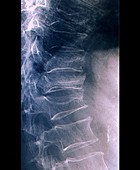 Osteoporotic spine, X-ray