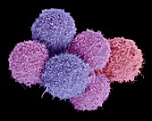 Bladder cancer cells, SEM