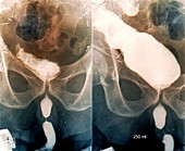 Augmented bladder, retrograde cystography