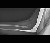 Elbow for prosthetic upper arm bone, X-ray