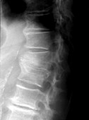 Osteoporotic spine, X-ray
