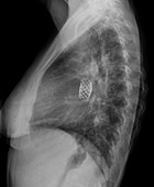 Congenital heart defects, X-ray