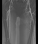 Blocked femoral artery, X-ray