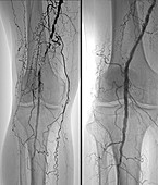 Treatment for blocked femoral artery, X-ray